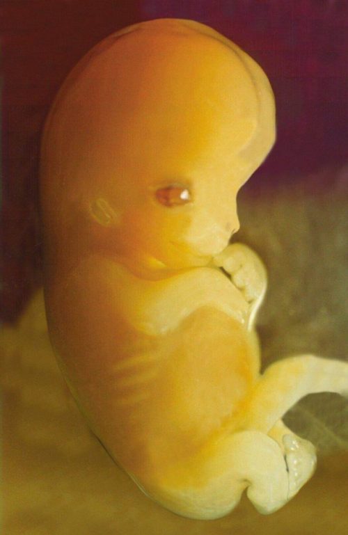 warfarinová embryopatie